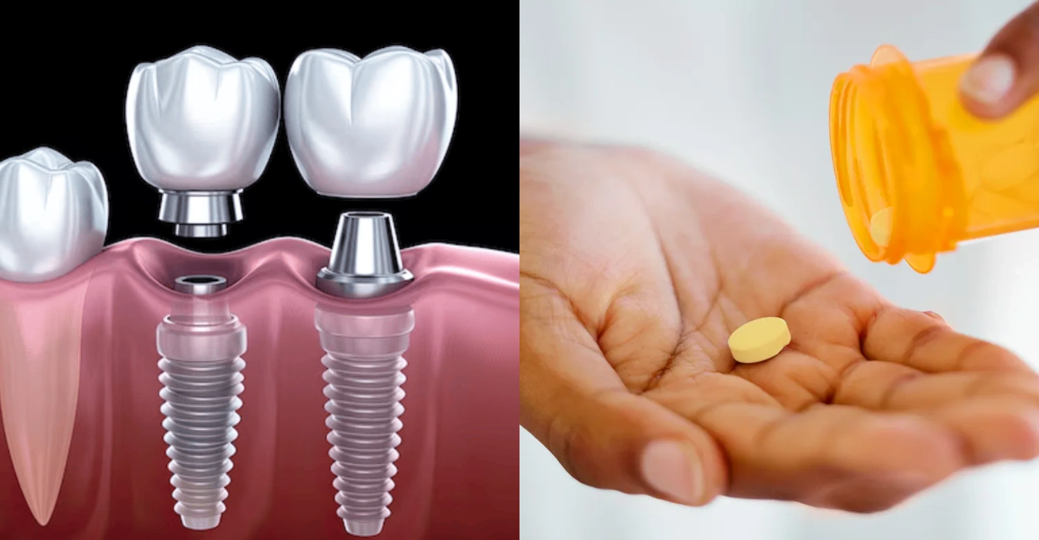 Methotrexate and dental implants inblog